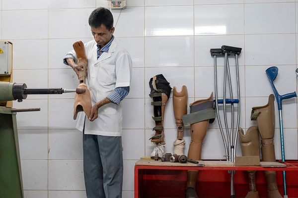 Artificial limbs change lives: Here’s how we can scale them up in low-income countries - Header Image